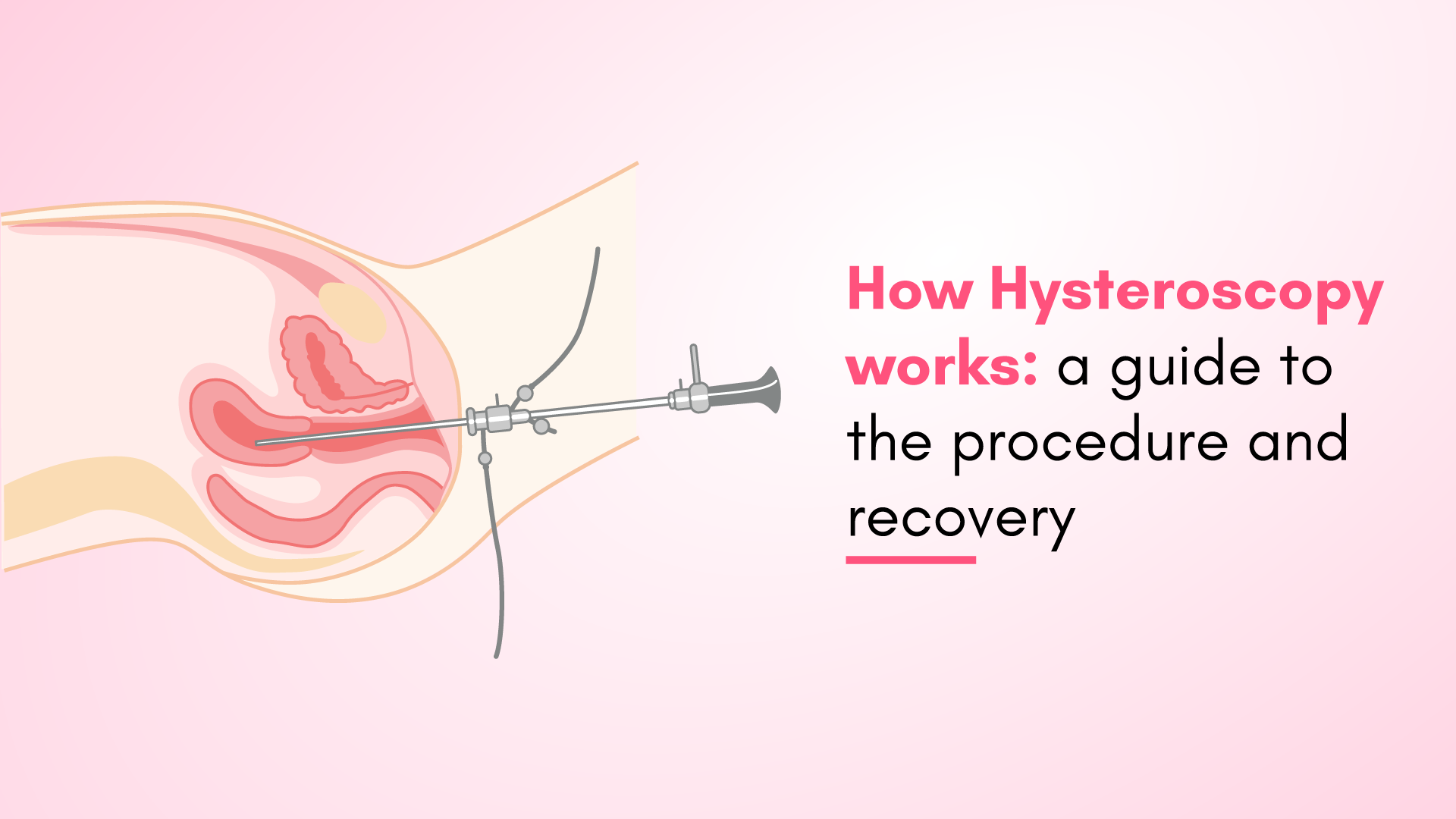 How Hysteroscopy Works: A Guide to the Procedure and Recovery