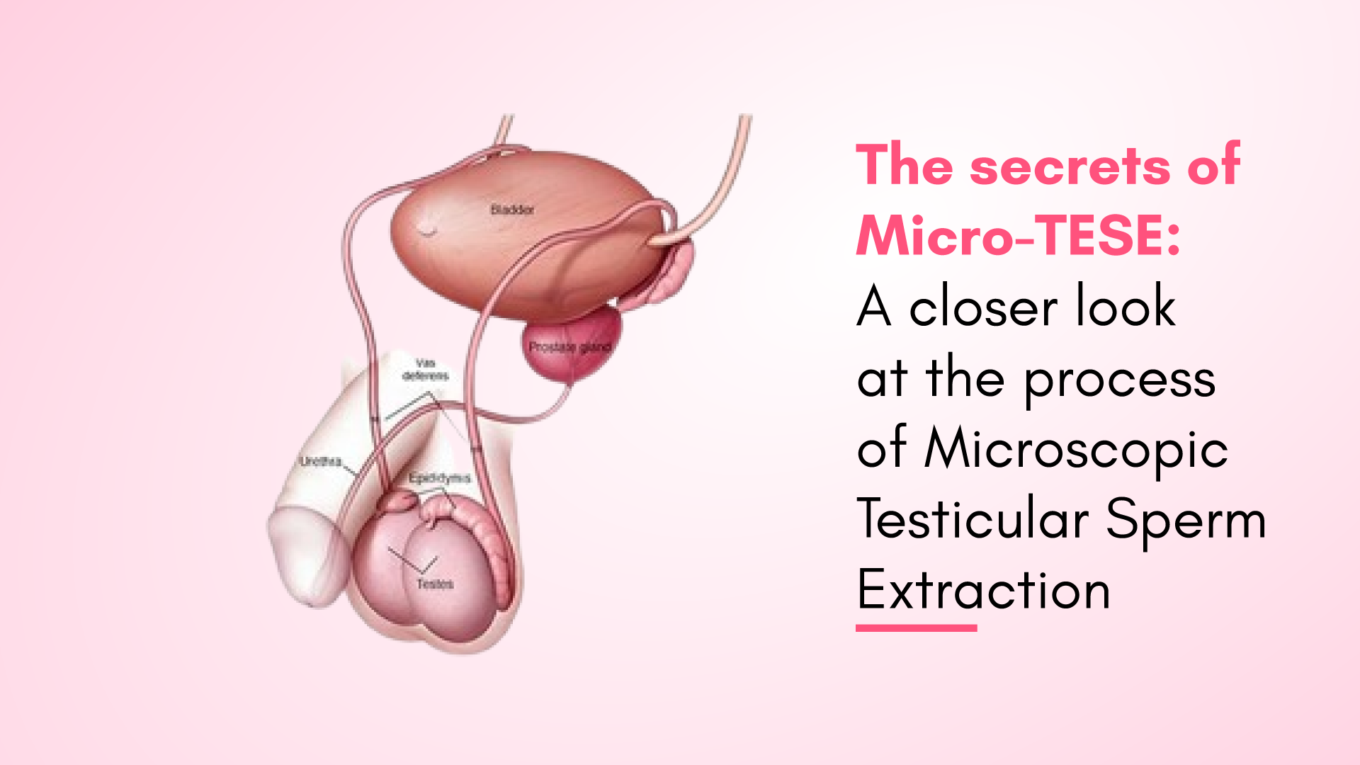 The Secrets of Micro-TESE: A Closer Look at the Process of Microscopic Testicular Sperm Extraction