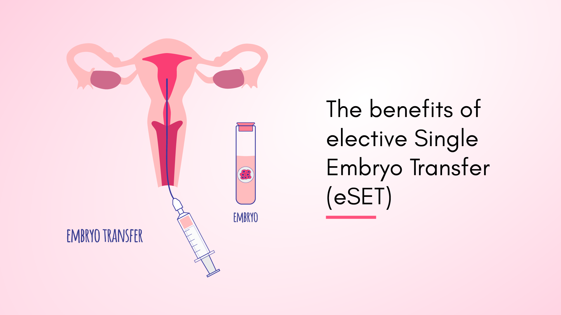 The benefits of Elective Single Embryo Transfer (eSET)