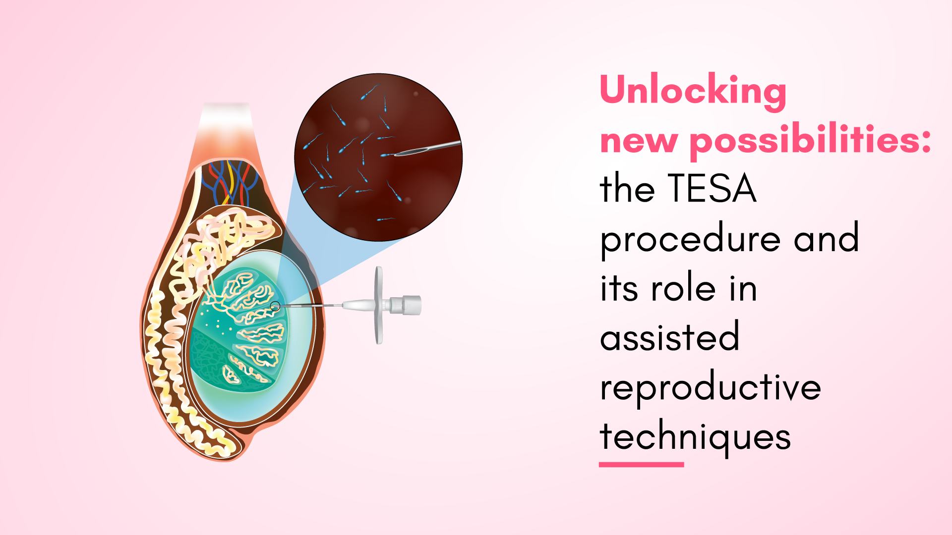 Unlocking New Possibilities: The TESA Procedure and its Role in Assisted Reproductive Techniques