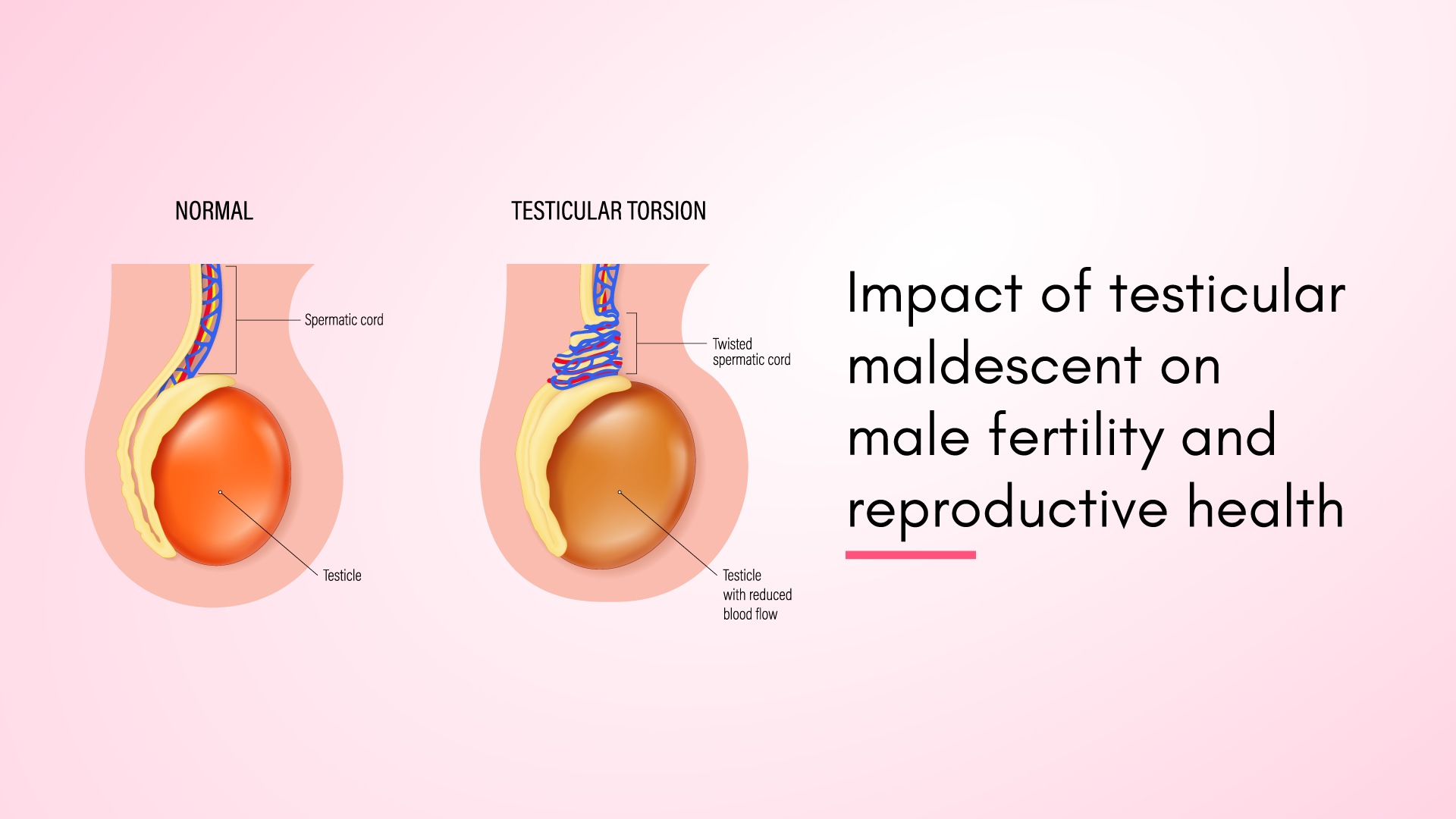 Impact of Testicular Maldescent on Male Fertility and Reproductive Health