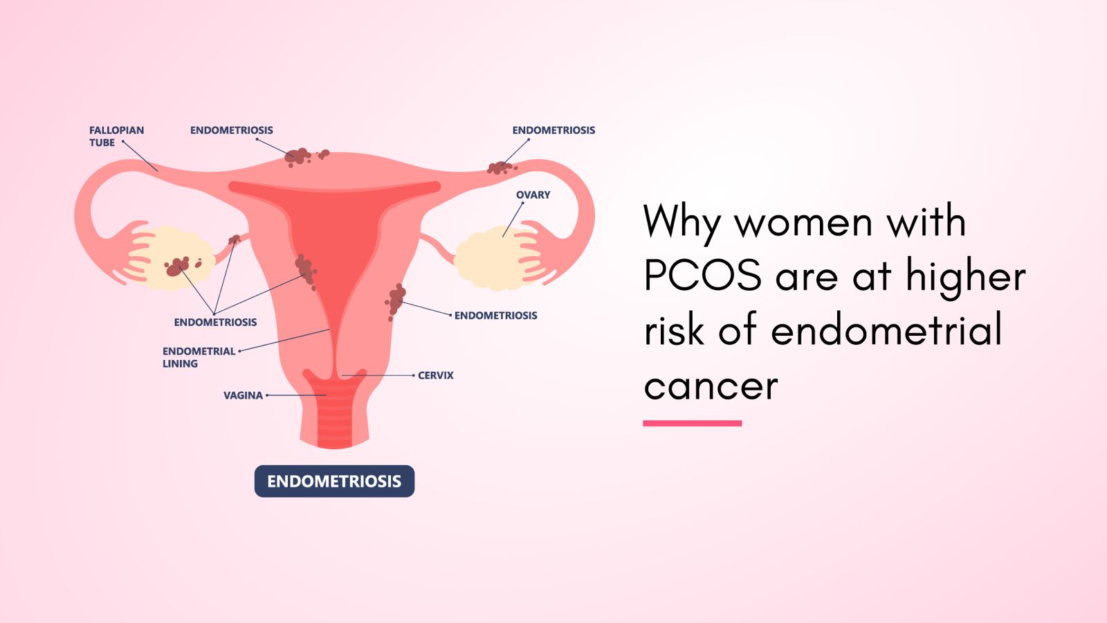 Why Women with PCOS Are at Higher Risk of Endometrial Cancer