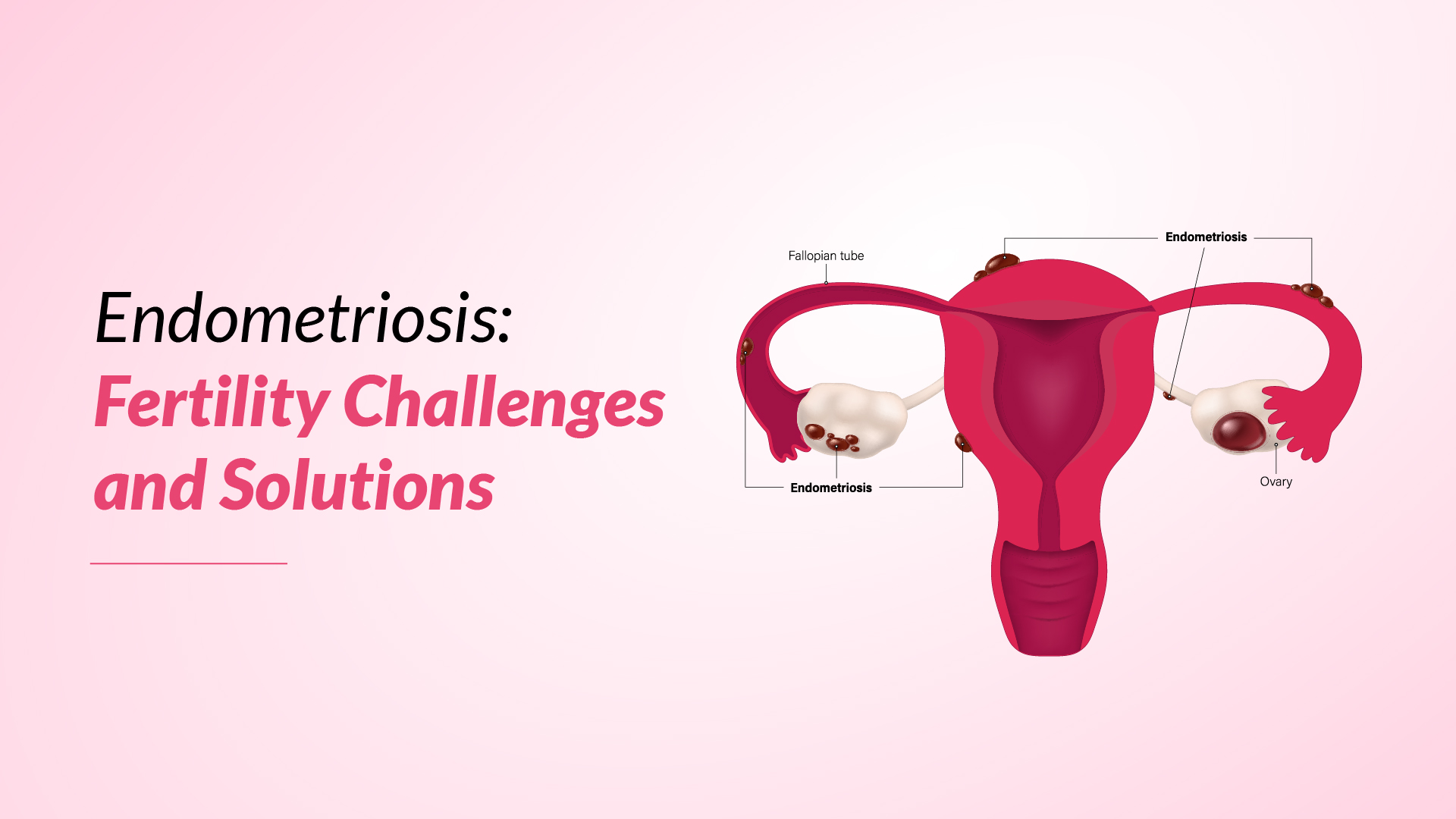 Endometriosis: Fertility Challenges and Solutions