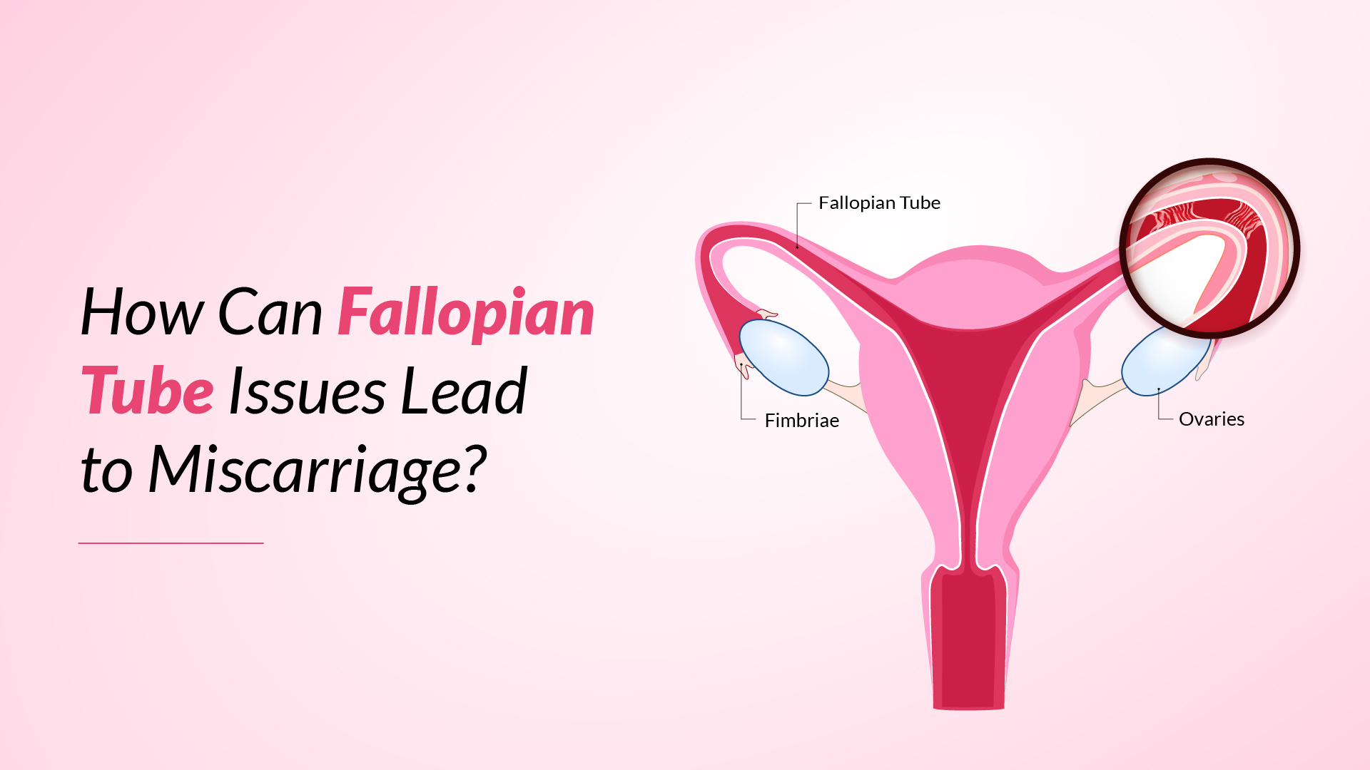 How Can Fallopian Tube Issues Lead to Ectopic pregnancy?